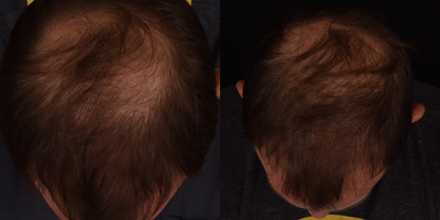 25-34 year old man treated with Hair Loss Treatment - Our blood consists of two main components, red blood cells and plasma. The plasma contains white blood cells and platelets that are rich in growth factors. By extracting and isolating these growth factors, specifically the platelet-rich fibrin or #PRF, we can harness the all-natural regenerative properties to stimulate the activity of hair follicles to promote new hair growth. There are no additives to this meaning this all-natural treatment is entirely from ones own body. Anyone experiencing hair loss is essentially a good candidate for PRF treatments, especially those who are experiencing early signs of hair loss.