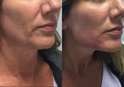 35-44 year old woman treated with Teosyal - Jaw augmentation