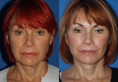 Quick Lift, Female - Quick Lift, Female