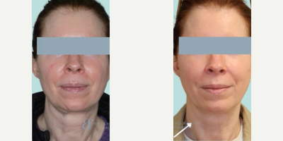 Woman treated with Thread Lift - Another happy patient 6 weeks after getting PDO threads.Check out that amazing improvement in jawline and neck.