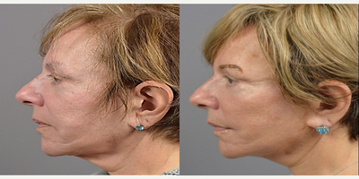 65-74 year old woman treated with EZ Lift, Grin Lift and Fat Injections - 67 year old female status post EzLift, Corner Mouth Lift / Grin Lift and Fat Injections.