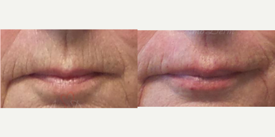 65-74 year old woman treated with Juvederm, Vollure, Restylane Silk - Treatment for lines above upper lip (smoker's lines) with filler injection (Juvederm, Belotero, Restylane Silk)