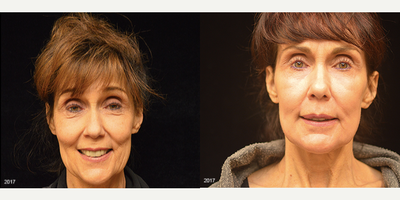Woman treated with MiXto Laser - MiXto Laser