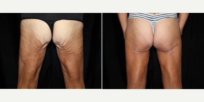 45-54 year old woman treated with Thigh Lift - Inner thighplasty, fat transfer to buttocks.