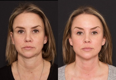 Woman treated with Thread Lift - Woman treated with Thread Lift
