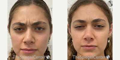 18-24 year old woman treated with Xeomin - Botulinum