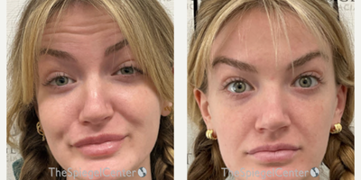 18-24 year old woman treated with Xeomin - Botulinum