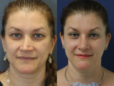 45-54 year old woman treated with Revision Rhinoplasty - Open Structure Revision Rhinoplasty