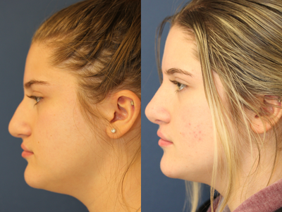 18-24 year old woman treated with Rhinoplasty - Open Rhinoplasty