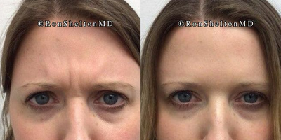 25-34 year old woman treated with Daxxify - 33 year old woman treated with Daxxify for forehead wrinkles. Before and after images taken 'at rest', when 'frowning' and when 'raised'.Note: she doesn't have the lower right forehead crease at rest I did not relax that line so that at rest her right eyebrow is now more symmetric as it was lower than her left eyebrow prior to treatment and if I had relaxed that last crease the right eyebrow would lower.