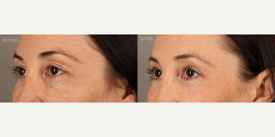Upper and Lower Blepharoplasty with Fat Grafting and CO2 Laser - 38-year-old female with a history of displeasure with her upper eyelid contour and excess skin, and lower eyelid aging. She had tried and failed undereye fillers many times before deciding to undergo surgery. She is shown 6 months after an upper blepharoplasty (eyelid lift) with fat transposition to reduce upper eyelid skin redundancy and create a more youthful contour. She also underwent a transconjunctival (scarless) lower blepharoplasty to remove lower eyelid bags, fat grafting to the eyelids and mid-cheek to contour areas of hollowness, and fractionated CO2 laser to tighten and smooth skin.