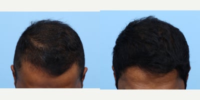 35-44 year old man treated with FUE Hair Transplant, Hair Transplant, Hair Loss Treatment, PRP for Hair Loss, PRP Injections - This patient had an FUE with another physician in the past and was pleased with results but still had scarcity in his crown and hairline. Dr. Wise performed an FUE hair transplant and PRP to achieve these results. He will continue to see growth up to one year.
