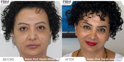 45-54 year old woman treated with Deep Plane Facelift, Double Eyelid Surgery - .