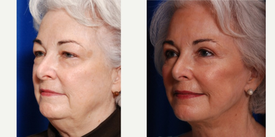 65-74 year old woman treated with Eyelid Surgery - upper and lower belpharoplasty