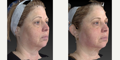 This woman was treated to smooth her skin and treat the blotchy appearance. - We used out patented tyte and bryte protocol which includes light therapies in combination with abrasion techniques. The color is more smooth, the skin is tighter, Looking good.