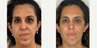 25-34 year old woman treated with Dermal Fillers, Collagen Injection - Facial Harmonization and rejuvenation with hyaluronic acid and bioestimulators