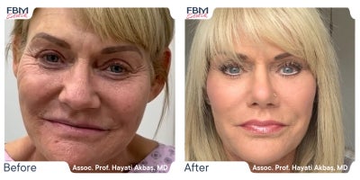 55-64 year old woman treated with Deep Plane Facelift, Facial Fat Transfer, Eyelid Surgery - 55-64 year old woman treated with Deep Plane Facelift, Facial Fat Transfer, Eyelid Surgery