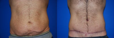 Tummy Tuck/Abdominoplasty/Liposuction -
The gentleman underwent a skin-only abdominoplasty (tummy tuck) with liposuction of his flanks.