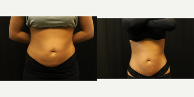 25-34 year old woman treated with HiFEM muscle stimulation treatment. - Patient received 4 treatments of HiFEM, a  non-invasive body sculpting machine that builds muscle and burns fat. These muscle contractions release free fatty acids which results in burning fat cells and defining ab muscles. This treatment is completely non invasive with no down time.