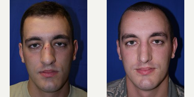 25-34 year old woman treated with Rhinoplasty - 25-34 year old woman treated with Rhinoplasty