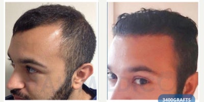35-44 year old man treated with FUE Hair Transplant - This 3544-year-old male patient came to our clinic with progressive frontal hair thinning and a receding hairline, which had been affecting his appearance and confidence. After a detailed consultation and donor area evaluation, he was considered an excellent candidate for a FUE hair transplant.The procedure was performed using the Follicular Unit Extraction (FUE) technique. A total of 3,400 grafts were carefully harvested from the occipital donor area and implanted into the frontal and parietal zones, restoring density and creating a natural-looking, age-appropriate hairline. To support healing and improve graft survival, one session of PRP therapy was also carried out during surgery.For post-transplant care, the patient was advised to follow a dedicated regimen, including Folliactiv shampoo and spray containing Saw Palmetto extract, to strengthen transplanted hair, minimize shedding, and ensure long-term results.The surgery was performed under local anesthesia with minimal discomfort, and the patient was able to return to daily activities within a few days. At follow-up, he achieved excellent density and a natural hairline that blended seamlessly with his facial proportions. The outcome provided a significant improvement in both his appearance and confidence.