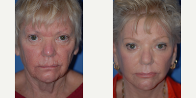 55-64 year old woman treated with Brow Lift - Natural appearing elevation of the brow creates a rejuvenated appearance