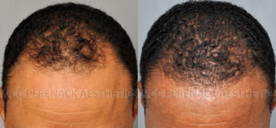 25-34 year old man treated with Hair Transplant - This patient was treated for for male pattern baldness with a receding hairline and thinning in the crown. He received 2000 grafts.