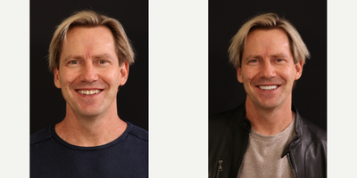 45-54 year old man treated with KoR Teeth Whitening, Porcelain Veneers - This patient opted for Porcelain Veneers on  his upper teeth & KOR whitening on his lower teeth to get the smile he'd been dreaming about for years!