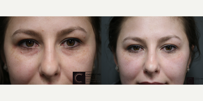 Under Eye filler with Vollure - Reduction of tired looking under eyes using Vollure as filler.