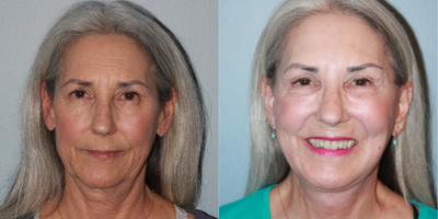 64 year old woman treated with Blue Peel - A Blue Peel was performed alongside of our exclusive LiteLift facelift. The Blue Peel improved her fines lines, and pigmentation giving her a smooth bright appearance to her skin. Additional procedures such as a lower facelift, upper/lower eyelids, temple lift, and fat transfer to her cheeks were added to balance the rejuvenation of her entire face for a comprehensive result. After photos were taken 3 months after surgery.