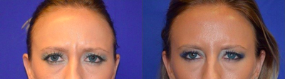 18-24 year old woman treated with Dysport - Dysport treatment to glabella and forehead