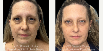 45-54 year old woman treated with Skin Lightening, Skin Rejuvenation, IPL - 35-44 year old patient treated with Elluminate with IPL Photofacial for skin concerns of age spots, sun damage and hyperpigmentation of the face. The result was an overall brightening of her skin and complexion and significantly improved age spots and sun spots giving her skin a more youthful appearance. These results were achieved after only one treatment in a series of 3.