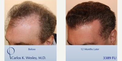 35-44 year old man treated with Hair Transplant - This 44-year-old man underwent a follicular unit transplantation (FUT) session with Dr. Carlos K. Wesley in which a total of 3389 grafts were placed. We are thrilled that our surgical facility is considered amongst the worlds best. Aspects of our surgical approach can be viewed on our sites Most Common Questions page. Three unique elements combined to help improve his experience: no-shave requirement for optimal discretion, enhanced graft storage measures, and rigid patient safety standards.  As with all of Dr. Wesleys patients, he was NOT required to cut his hair for the procedure.  As a result, this patient was able to return comfortably to work and social activities within approximately 7-10 days of his procedure. The patients hair follicles were incubated in platelet rich plasma (PRP) throughout the duration of the procedure.  This, combined with an ATP-containing storage solution has been shown to enhance survival of transplanted hairs.