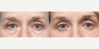 55-64 year old woman treated with Eyelid Surgery - Dr. Wise performed a lower transconjunctival blepharoplasty on this 63-year-old patient to remove the bags below her eyes and to rejuvenate her eyes with long lasting results. Her results are shown two months post-op.