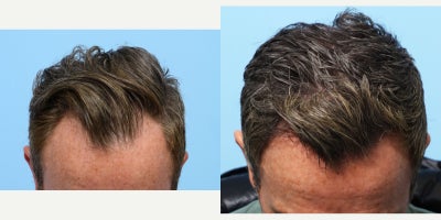 45-54 year old man treated with FUE Hair Transplant, Hair Transplant, Hair Loss Treatment, PRP for Hair Loss, PRP Injections, Aq - This 45-year-old patient had recession on his forehead, specifically around his widows peak, and hair loss in his crown area. Dr. Wise performed an FUE transplant to fortify the front and add density to his crown area. During the procedure, the patient also had PRP injections to the his scalp to fortify the hair follicles and expedite healing.