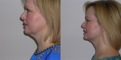 35-44 year old woman treated with Kybella - 43 year old female height 50 and weight 125 pounds. See before and one month after a second session of Kybella injected into the area beneath the chin. Each seesion used two vials of Kybella. The patient experienced mild swelling which was less with each session. She went on to have third session using two vials of Kybella.