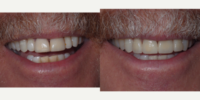 55-64 year old man treated with Da Vinci Veneers - Patient was unhappy with his front two old crowns. They were out of proportion with his other teeth and just ugly.We replaced&nbsp;them with new crowns and doing porcelain veneers on the two adjacent teeth