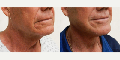 Man treated with Facelift - Man treated with Facelift