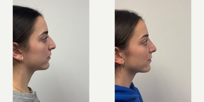 18-24 year old woman treated with Rhinoplasty - 6 months after a Rhinoplasty
