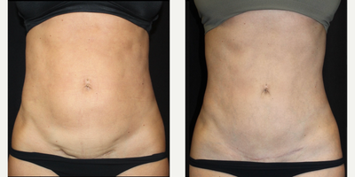 Woman treated with Belly Button Surgery - Woman treated with Belly Button Surgery