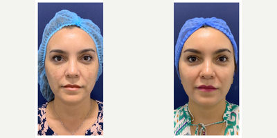 45-54 year old woman treated with Cosmelan - Treatment for melasma in a 45-year-old woman. An application in the office and post treatment kit to continue at home.