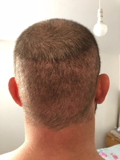 4 000 Grafts With Clinic Expert Istanbul Review Realself
