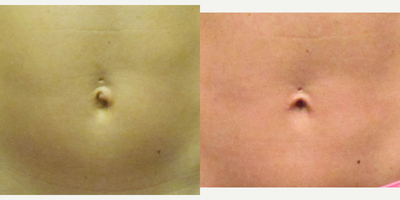 Tummy Tuck Results for this 43-year-old Woman - Mini Tummy Tuck, Hernia Repair, and Belly Button Surgery for this 43-year-old woman.
