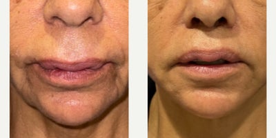 65-74 year old woman treated with Silicone Injection Removal - 70 yeal old woman who underwent biopolimer removal from the upper lips at the time of facial rejuvenation surgery