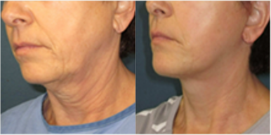 55-64 year old woman treated with Lower Facelift - Lower Face and Neck Lift