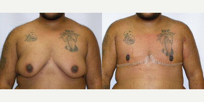 25-34 year old man treated with FTM Chest Masculinization Surgery - Patient is 7 days post-op.