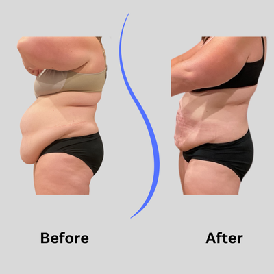 45-54 year old woman treated with Funsculpting HD Liposuction - 45-54 year old woman treated with Funsculpting HD Liposuction Lipo360 before and after photos at 90 days. Patient down 7 inches in 1 session.
