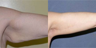 55-64 year old woman treated with Arm Lift - brachioplasty