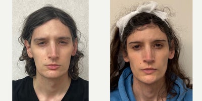 25-34 year old woman treated with Adam's Apple Reduction, Rhinoplasty, Forehead Reduction, Brow Bone Reduction, Genioplasty, Fac - this is a young lady who had forehead feminization, septorhinoplasty, and chin feminization.