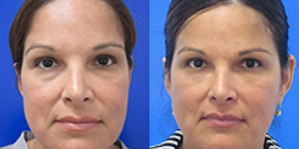 45-54 year old woman treated with Non Surgical Face Lift - Patient thought she looked tired and wanted to look refreshed.